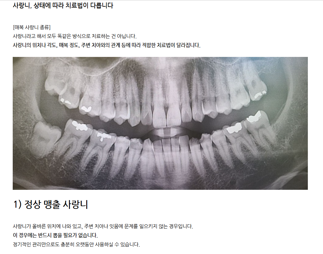 사랑니 상태에 따른 치료법 - 치과 X-ray 이미지